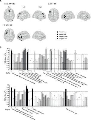 Altered Cortical Functional Networks in Patients With Schizophrenia and Bipolar Disorder: A Resting-State Electroencephalographic Study